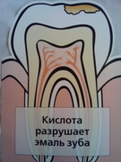 Лечение поверхностного и среднего кариеса зубов