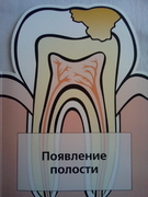 Лечение глубокого кариеса зубов