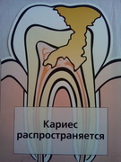 Лечение пульпитов и периодонтитов зубов